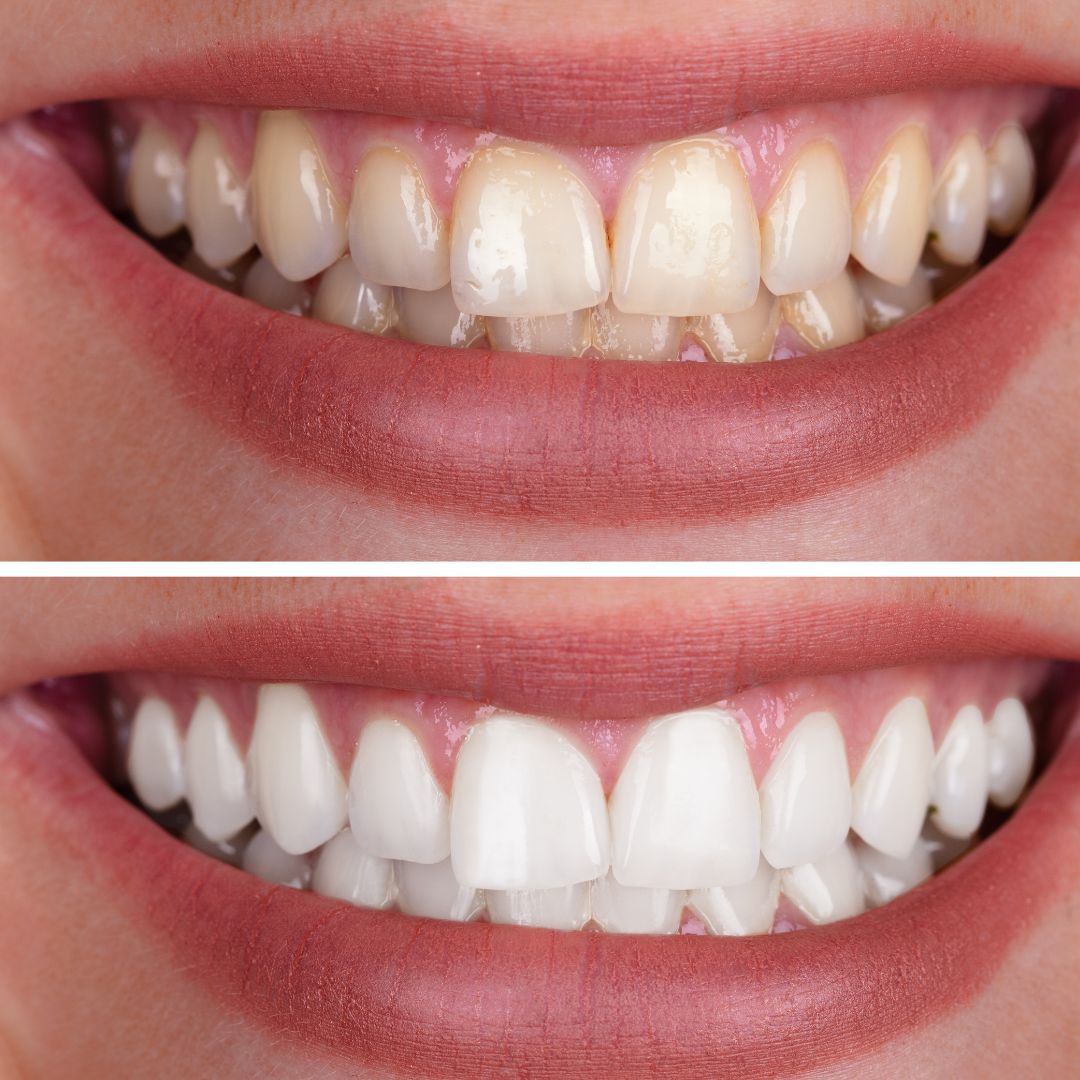Teeth Whitening in sikar