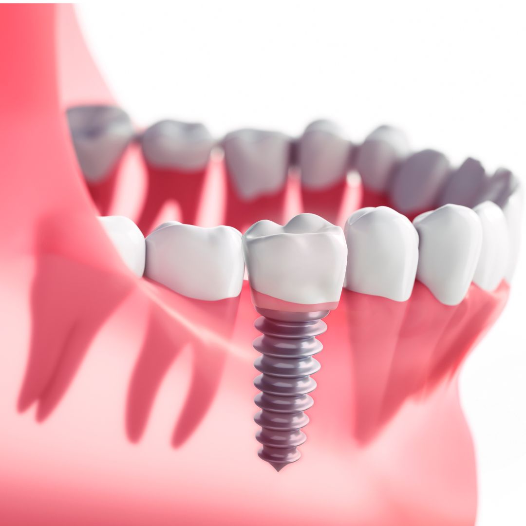 Dental Implants in sikar